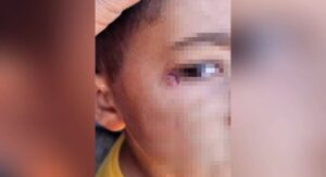 Şanlıurfa’da Öğrencinin Yüzünde Sigara Söndürüldü