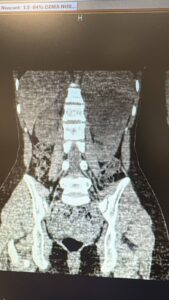 Şanlıurfa Viranşehir’de 10 Santimlik Böbrek Kisti Alındı